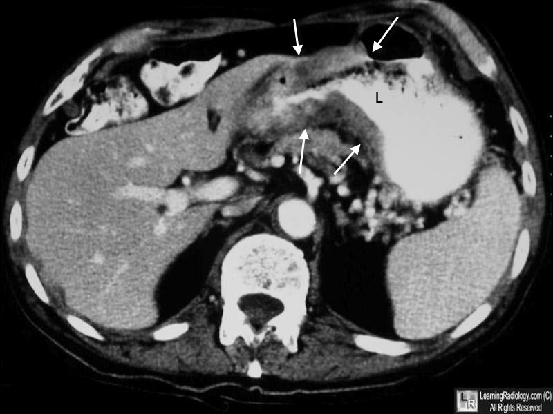 Carcinoma of the Stomach, CT